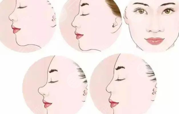 【假體隆鼻一至七天照片前后變化】  　　手術前