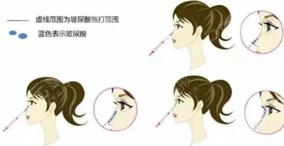 網(wǎng)友玻尿酸隆鼻親身經(jīng)歷|案例分享  術(shù)前