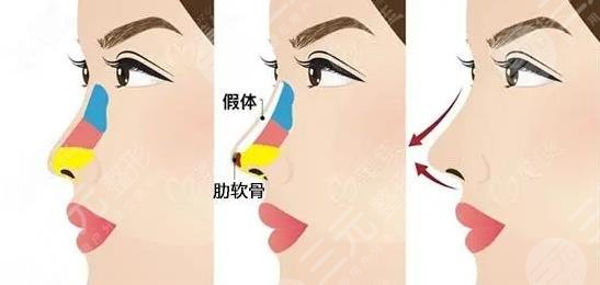 中山人民醫(yī)院隆鼻怎么樣？