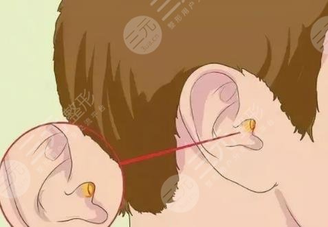 耳畸形再造手術