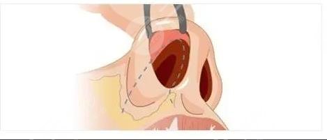 鼻子修復(fù)必須要滿3個(gè)月嗎？二次鼻整形術(shù)前指南！小白必看~