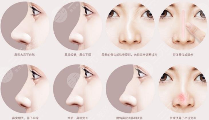 鼻子修復(fù)必須要滿3個(gè)月嗎？二次鼻整形術(shù)前指南！小白必看~