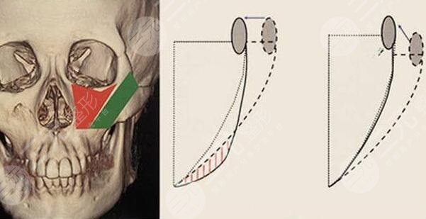 磨顴骨有風險嗎？