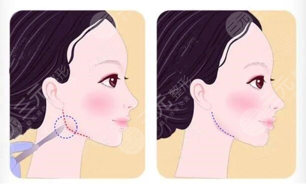 女士肥胖下頜角整形注意事項