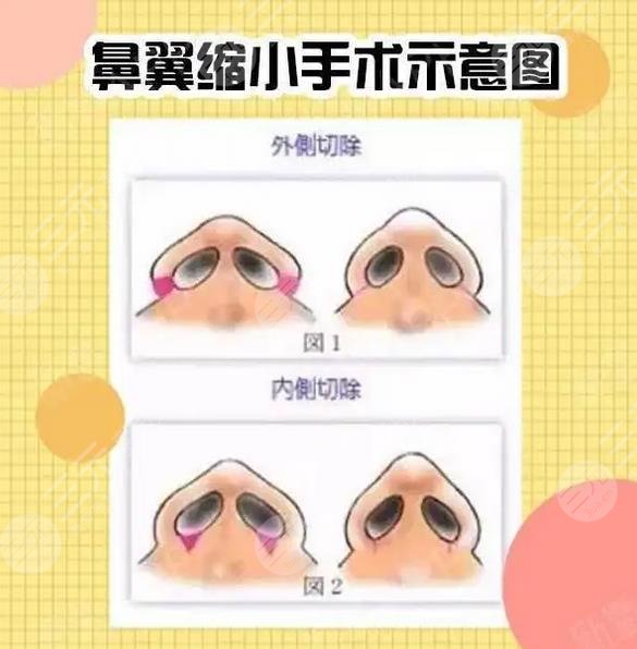 蒜頭鼻縮小整形高嗎