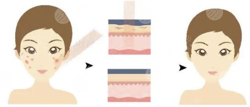 點(diǎn)陣激光后恢復(fù)過(guò)程圖