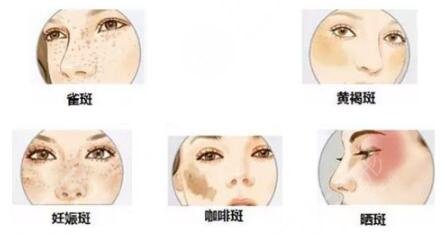 激光祛斑之后的護(hù)理措施有哪些呢?