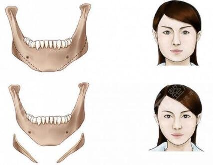 v-line瓜子臉手術(shù)是磨骨嗎