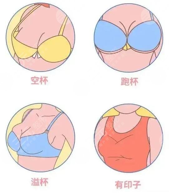 哪種豐胸方法比較好?