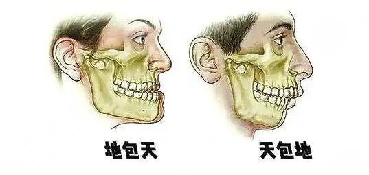 天包地矯正后臉型變化圖共享，矯正前的“如花”，矯正后的“側(cè)顏女神”~