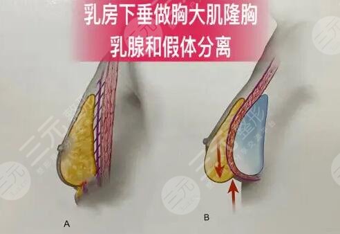 法國ES隆胸假體