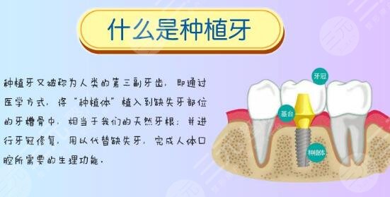 全口種植牙種幾顆？2種不同技術(shù)介紹！附價(jià)格表+口腔醫(yī)院3家~