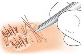 植發(fā)多少錢(qián)