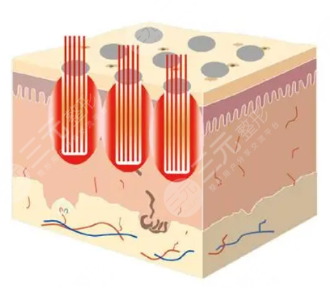 河北省二院點陣激光掛哪個科