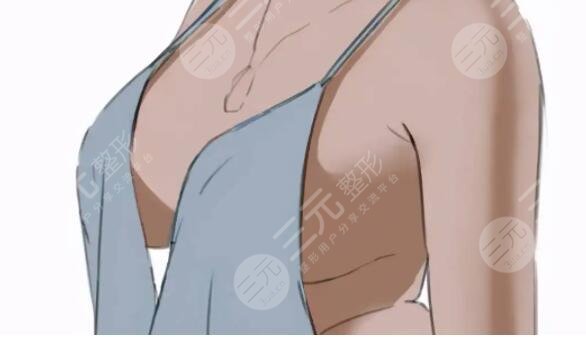 隆胸假體可以放一輩子嗎？擠了會(huì)不會(huì)變形？一輩子不取出會(huì)怎么樣？美胸必看！