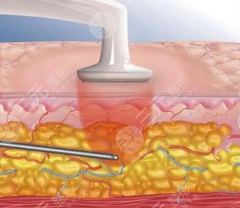 四川省人民醫(yī)院抽脂手術(shù)做得如何