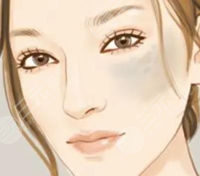 汕頭中心醫(yī)院祛斑案例