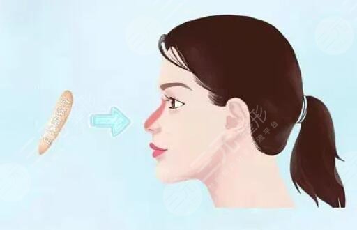 隆鼻1到7天恢復(fù)過(guò)程圖片