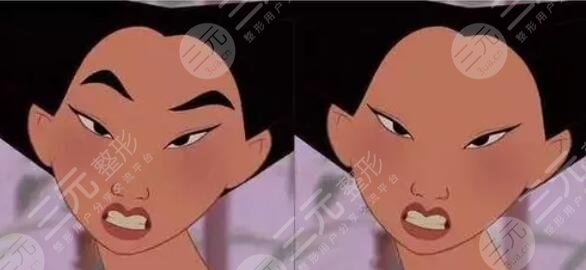 激光洗眉后1至7天的變化圖貼出，短短一周能恢復(fù)到什么程度？果嗎？