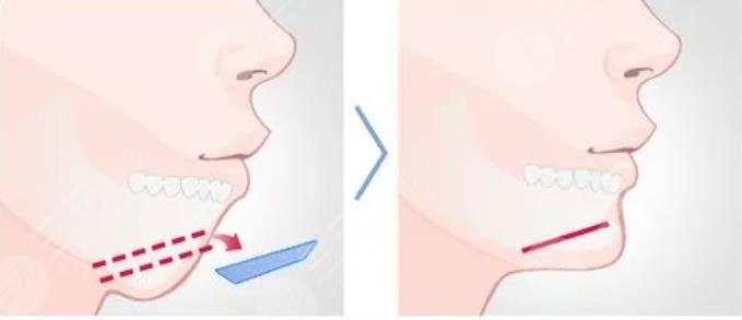 女人后縮下頜角整形優(yōu)勢(shì)