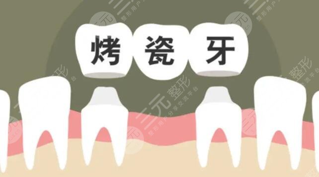 烤瓷牙多少錢(qián)一顆價(jià)格表2022全國(guó)，烤瓷牙壽命可以保持幾年？收藏不虧！