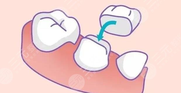 烤瓷牙多少錢(qián)一顆價(jià)格表2022