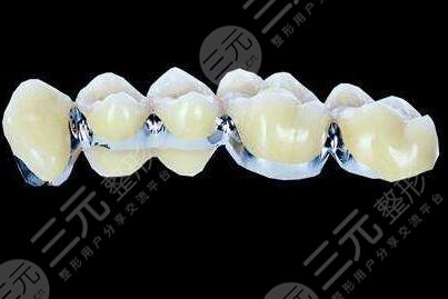 烤瓷牙能保持幾年壽命？