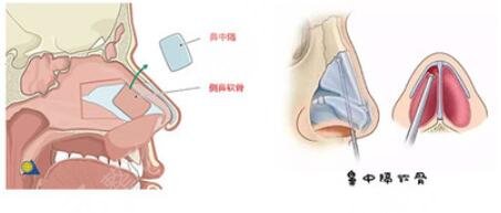 半肋骨鼻和全肋骨鼻的區(qū)別是什么？