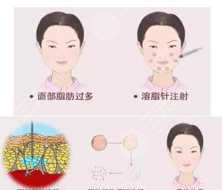 全臉脂肪填充術(shù)后注意事項(xiàng)