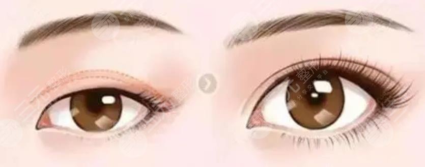 北醫(yī)三院安陽割雙眼皮案例