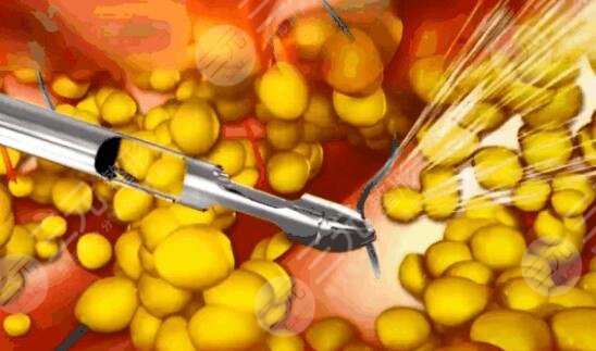 腹部吸脂手術前要注意的事項