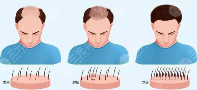 種植發(fā)真的靠譜嗎