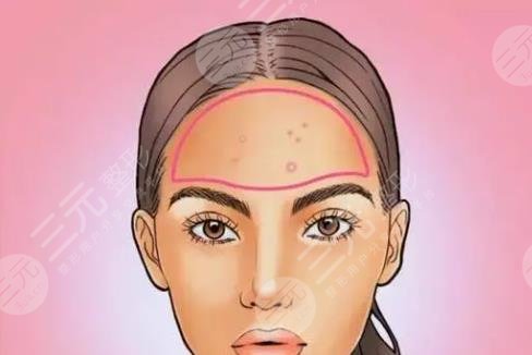 額頭長(zhǎng)痘