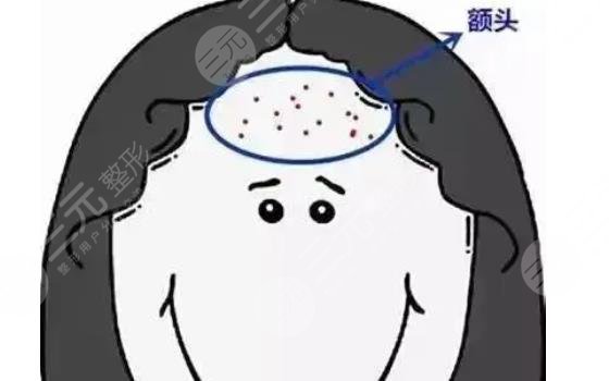 額頭長(zhǎng)痘