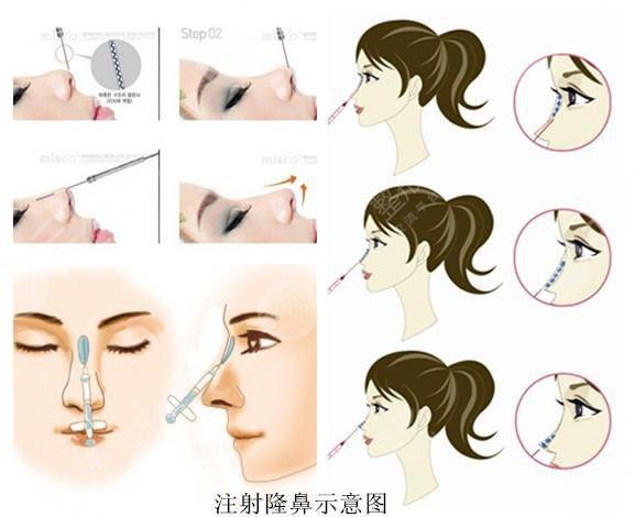 四川華西醫(yī)院注射瘦臉費(fèi)用是