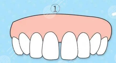 牙縫怎么修補(bǔ)