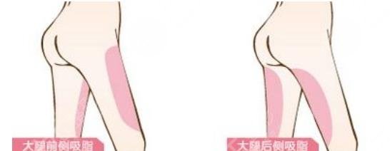瘦大腿吸脂價格