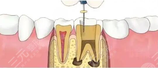 根管緩解后悔一輩子是真的嗎？為什么會后悔？根管緩解果可以維持多久？