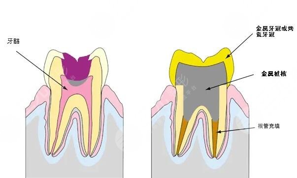 根管緩解持時間是多久？