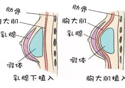 假體隆胸手感和真的有沒有區(qū)別?