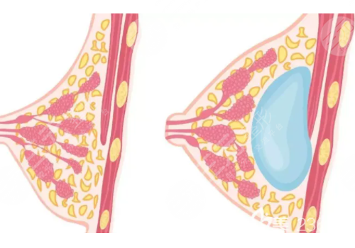 假體隆胸手感和真的有沒有區(qū)別?