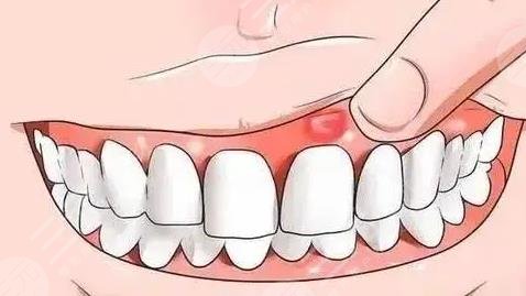 牙齦腫痛有膿包怎么辦?