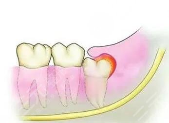 牙齦腫痛有膿包怎么辦?