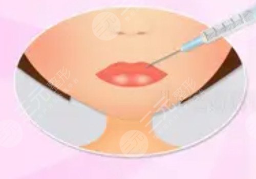 厚嘴唇怎么變??？