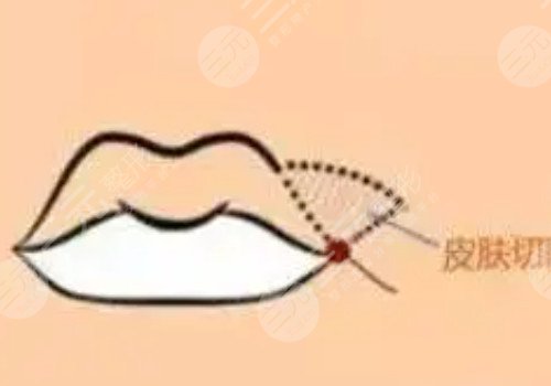 厚嘴唇怎么變薄？