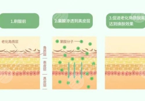 果酸美白果好嗎?