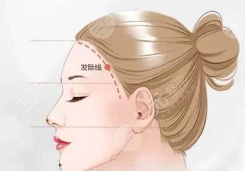 發(fā)際線移植能保持多久？