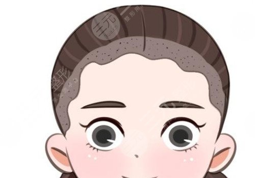 發(fā)際線移植能保持多久？