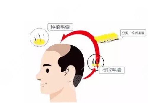 發(fā)際線移植能保持多久？
