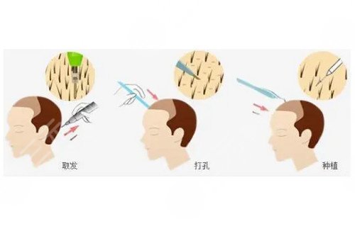 發(fā)際線移植能保持多久？